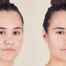 how to hide pimples without makeup